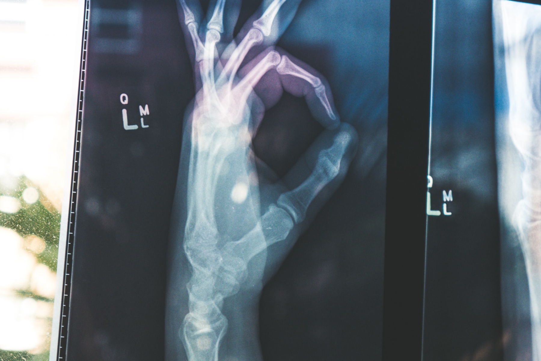 Radiography / hand